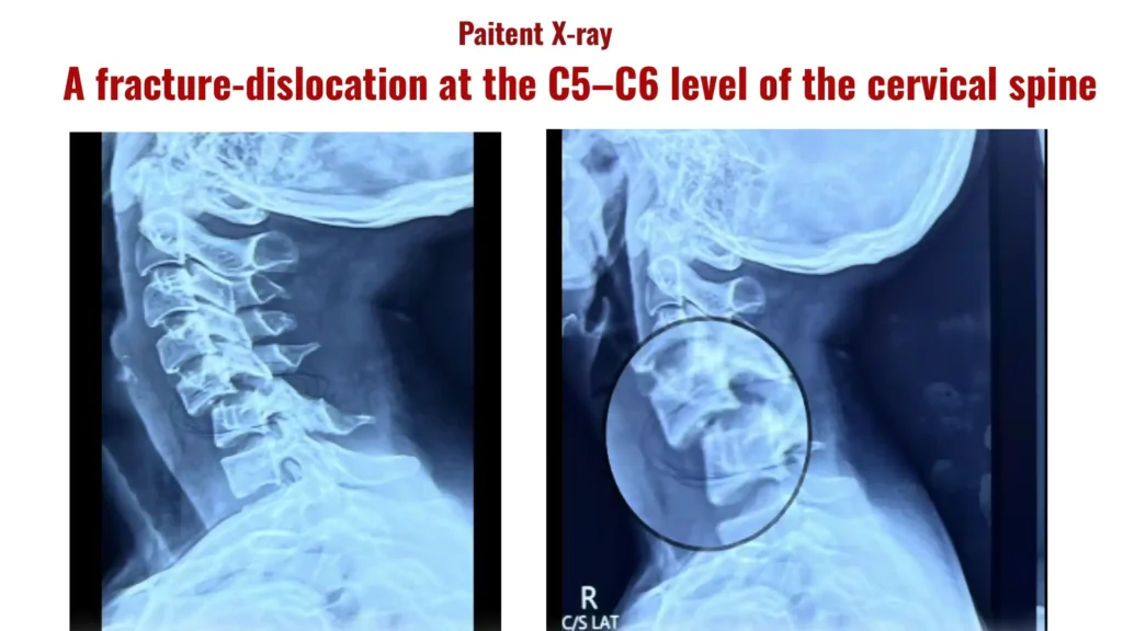 Pre-operative imaging demonstrating cervical fracture dislocation with spinal cord compression