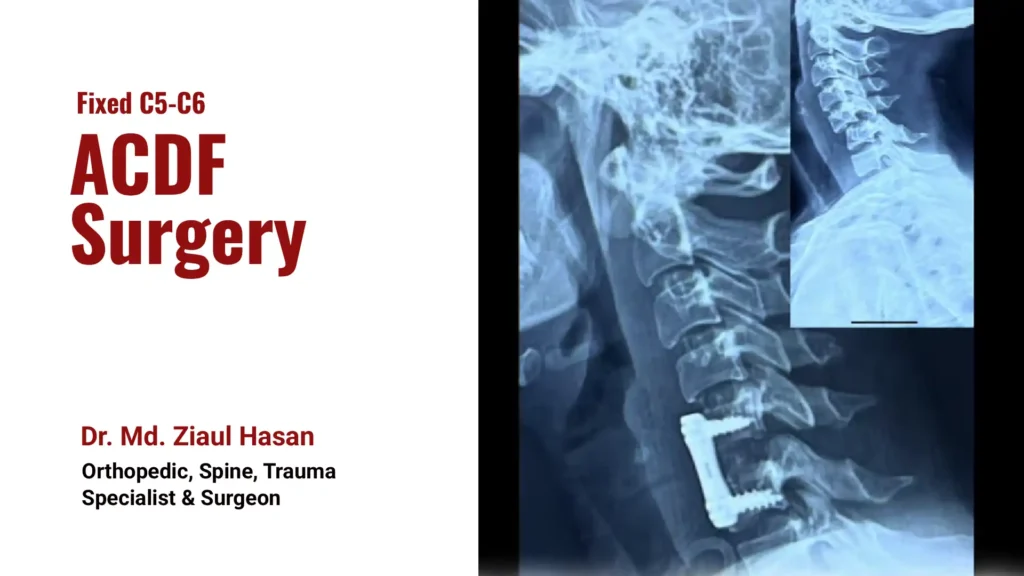 c5-c6 - ACDF surgery in Bangladesh | Dr Ziaul Hasan | Spine Surgeon