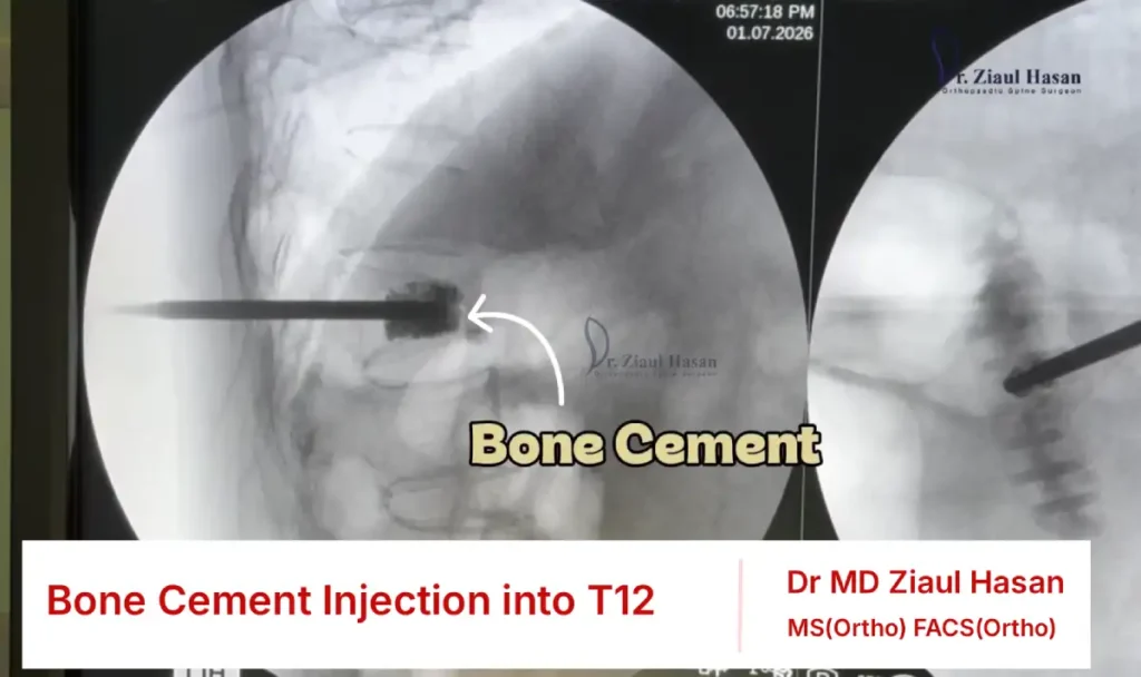 Bone cement distributed within the fractured T12 vertebral body under C-arm guidance.