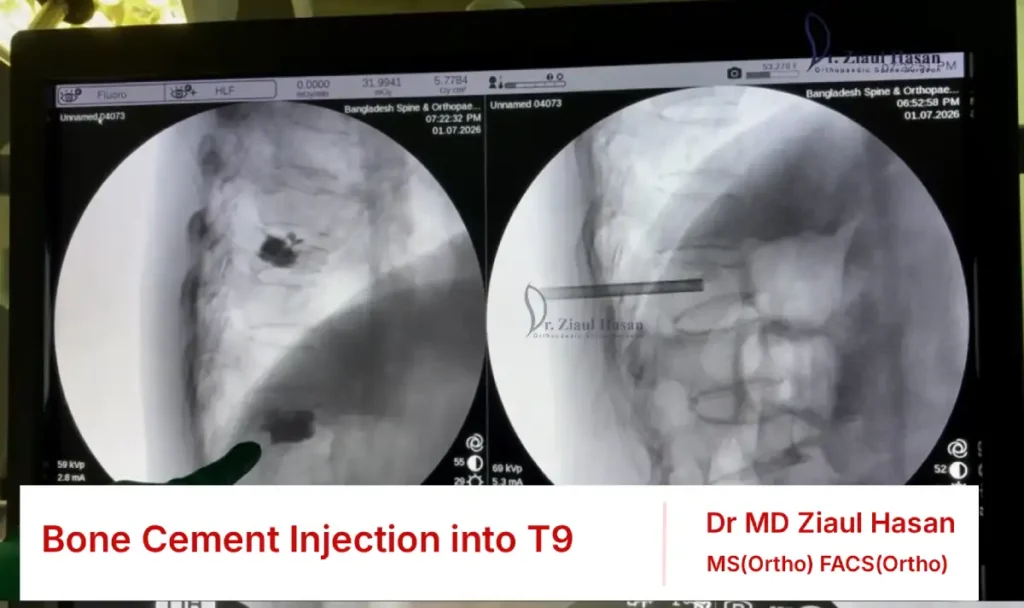 Bone Cement Injection into T9