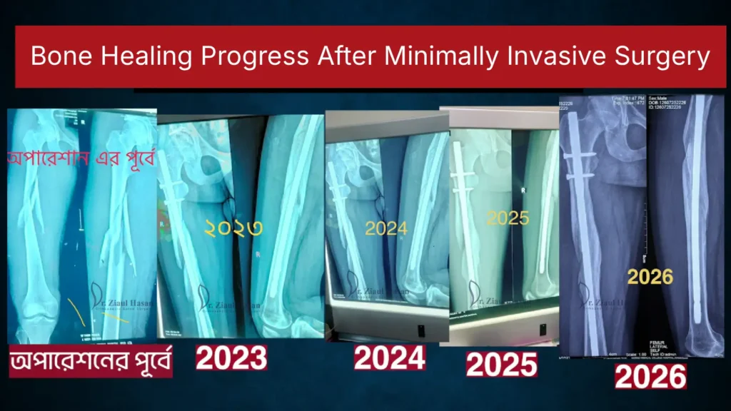 Bone healing progress after minimally invasive surgery
