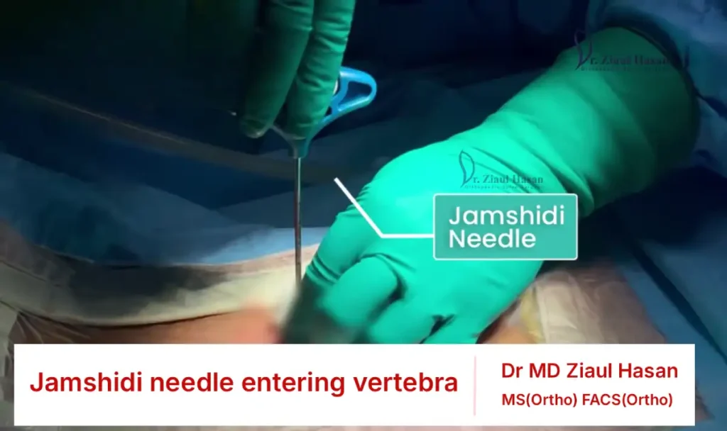 Jamshidi needle positioned into the fractured vertebral body under C-arm guidance.