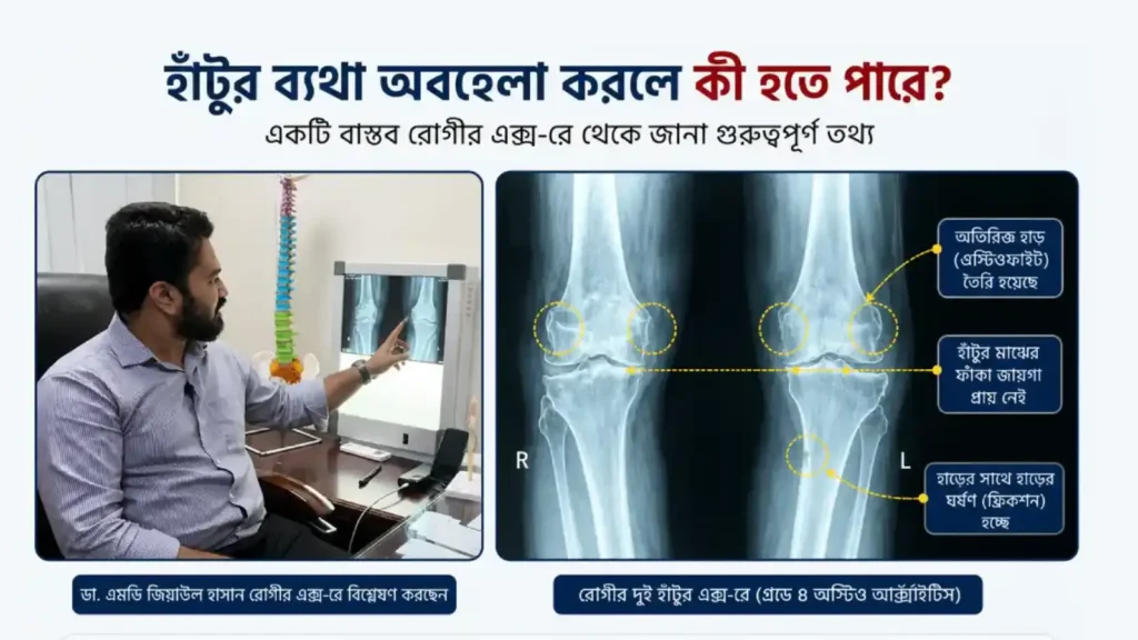 Knee-joint-Pain-stage-4-ostoartharitics-patient-case