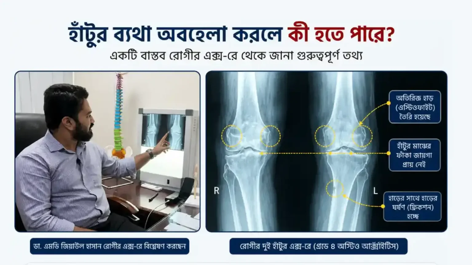 Knee-joint-Pain-stage-4-ostoartharitics-patient-case
