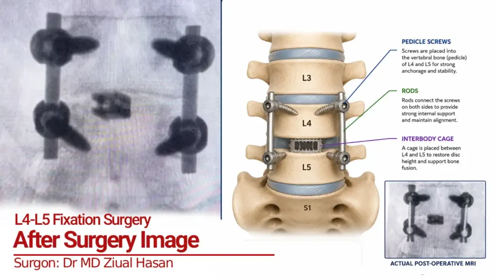 L4-L5 Fixation image after spine surgery in Dhaka | Surgeon: Dr MD Ziaul Hasan
