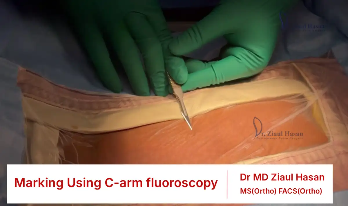 C-arm imaging is used to identify and mark the target vertebral level before needle placement.