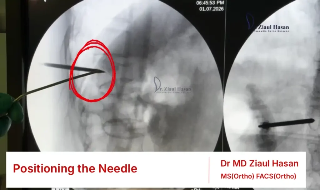 Lateral C-arm view used to confirm the needle position inside the fractured vertebra.