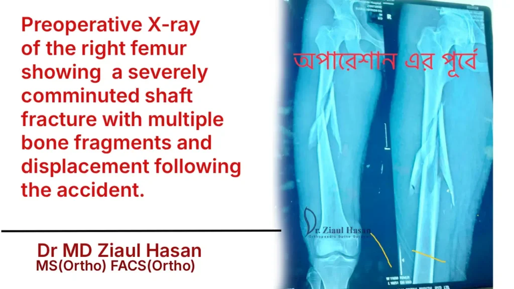 Preoperative X-ray of the right femur showing a severely comminuted shaft fracture with multiple bone fragments and displacement following the accident.