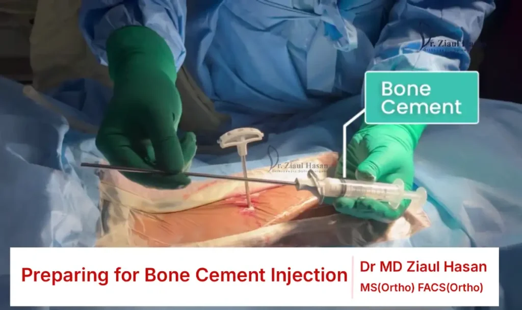 Bone filling device positioned for controlled bone cement injection.