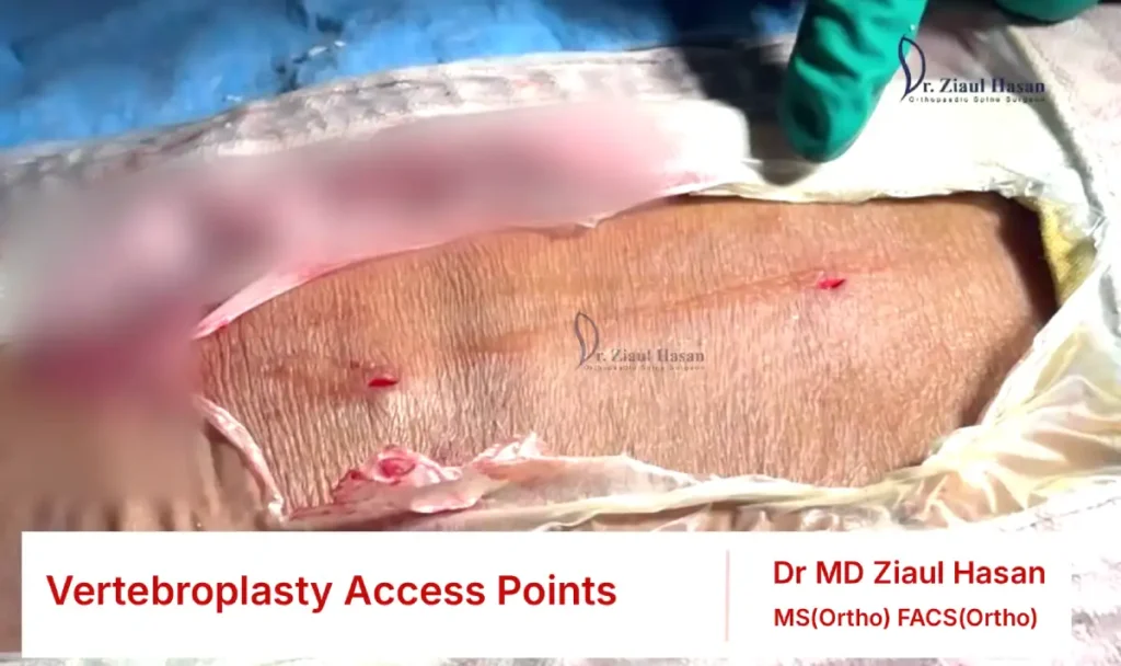 Vertebroplasty access point - smaller cut