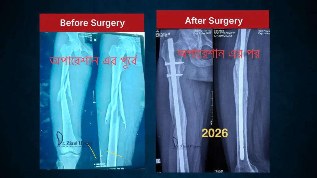 X-ray showing healed femoral shaft fracture with stable fixation 3 years after minimally invasive orthopedic surgery