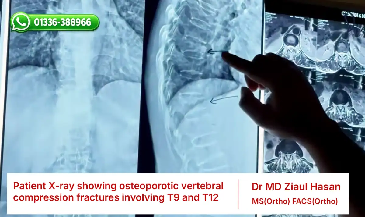 Patient X-ray showing osteoporotic vertebral compression fractures involving T9 and T12